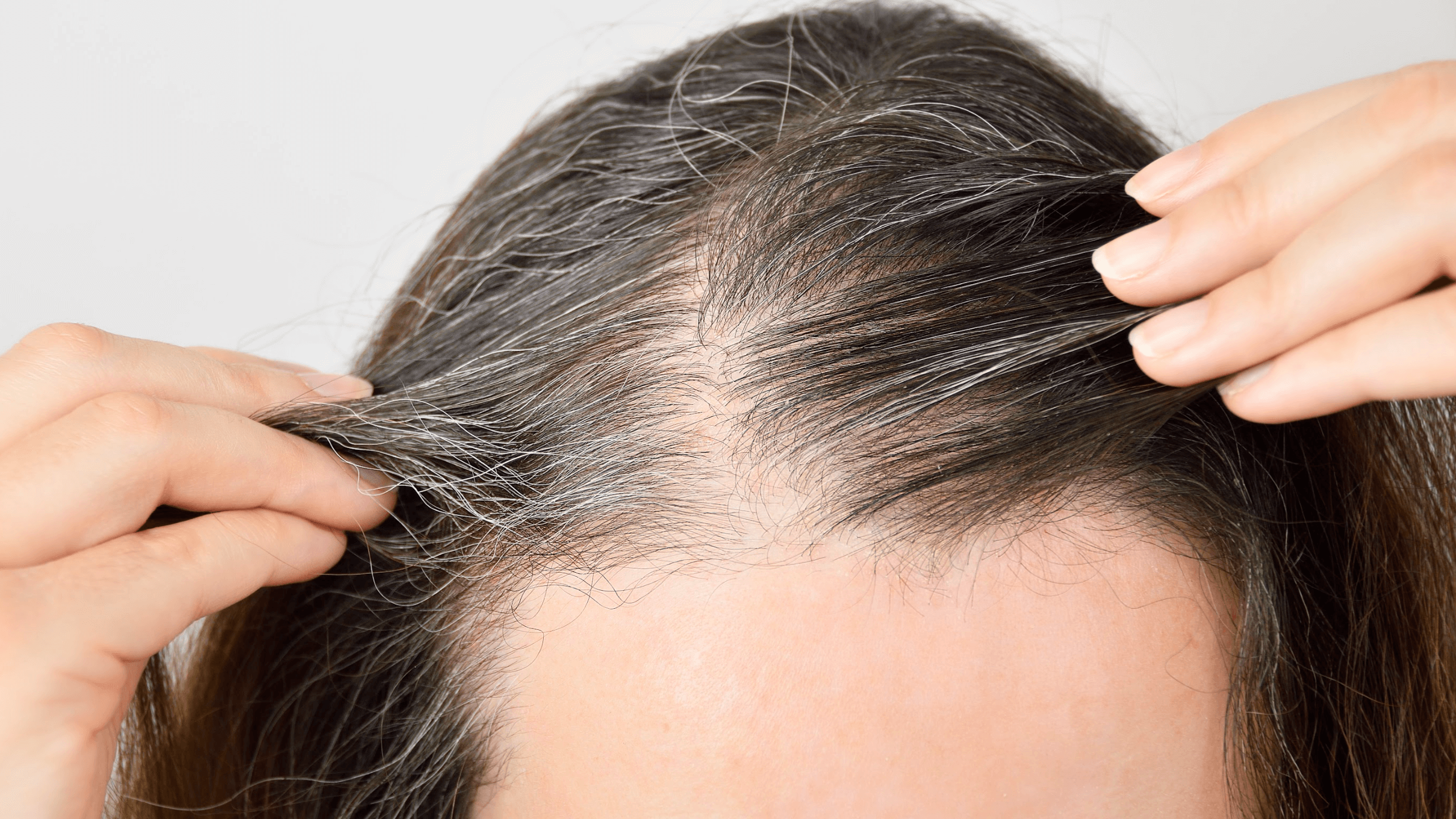 I Have a Receding Hairline. Can PRP Therapy Help It Grow Back